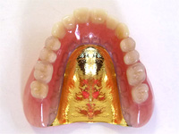金床義歯